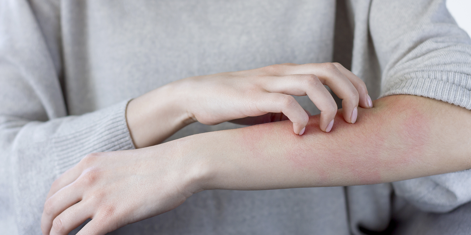 mujer rascando su brazo irritado